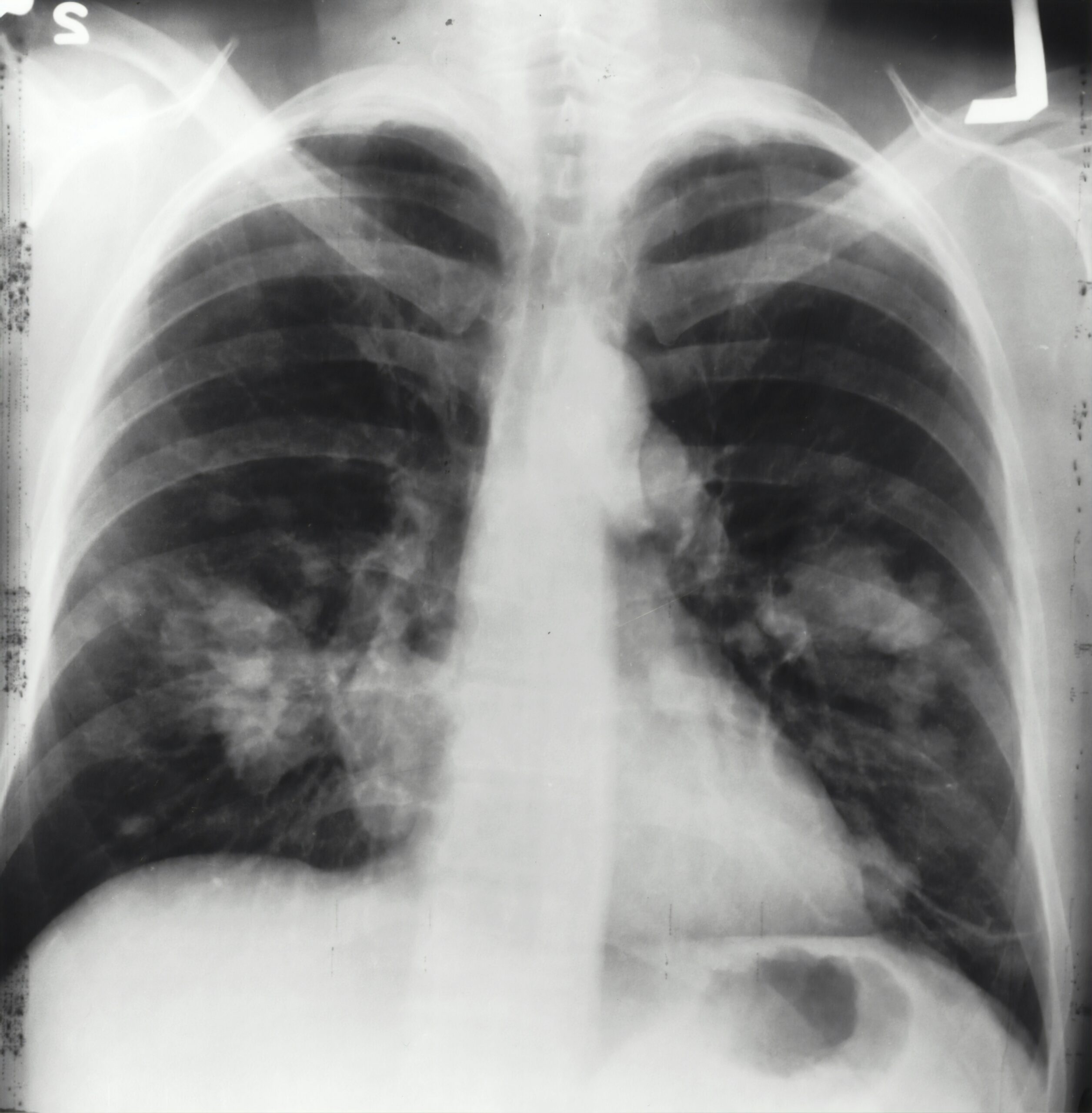 Chest Screening Benefits